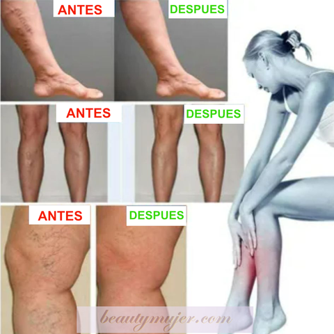 30 Parches de Varices para Circulacion