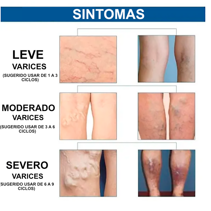 30 Parches de Varices para Circulacion